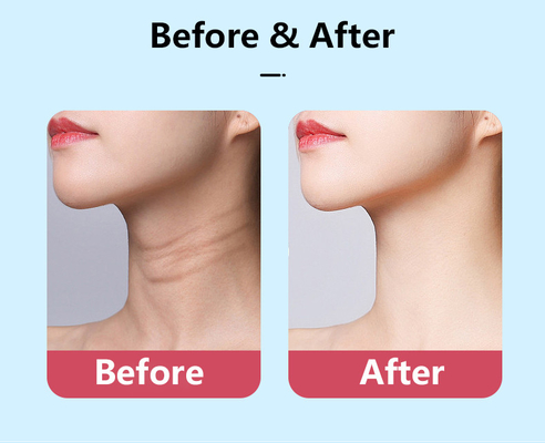 قدرت نامی 2.5W LED Therapy گردن جوان سازی ماساژور ضد پیری V-Face Lifting